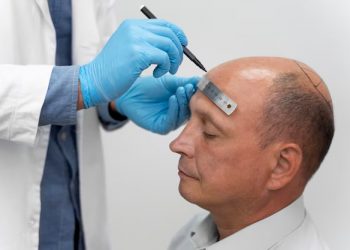 The Ultimate Guide to 3SE Examination Method and the Safest Implantation DHI Hair Transplant Using the Manual Punch FUE Technique