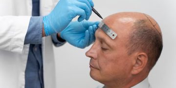The Ultimate Guide to 3SE Examination Method and the Safest Implantation DHI Hair Transplant Using the Manual Punch FUE Technique